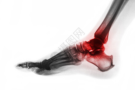 脚踝关节炎 足部X光片 横向视图 反向颜色风格 Gout 或风湿概念疼痛痛风跟骨病人扫描脚跟x射线扭伤射线跗骨背景图片