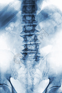 脊柱炎老年病人的薄膜X射线 lumbosacal脊椎显示骨质疏松 从降解过程中折断脊椎 Front View脊柱腰椎疾病解剖学疗法椎骨背景