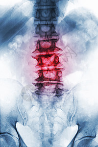 老年病人的薄膜X射线 lumbosacal脊椎显示骨质疏松 从降解过程中折断脊椎 Front View整骨衰老骶骨脊柱扭伤疾病骨背景图片