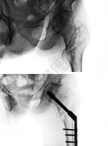 转子间骨折股骨 大腿骨 髋关节 X 光片以及手术前 上图 和手术后 下图 的比较 患者接受手术并插入髓内钉射线创伤治疗外科男人骨背景