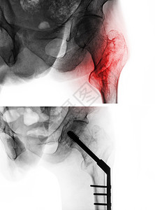 术前术后转子间骨折股骨 大腿骨 髋关节 X 光片以及手术前 上图 和手术后 下图 的比较 患者接受手术并插入髓内钉骨科扫描医生指甲治疗射背景