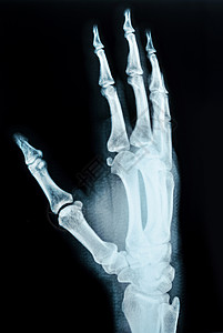 手腕骨折人手X光照片手腕风湿病拇指诊断疾病骨科创伤病人骨折手指背景