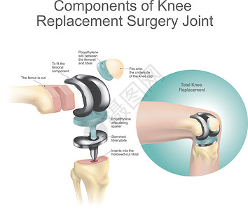 膝关节置换手术关节的组成部分 卫生保健 人体解剖学插画