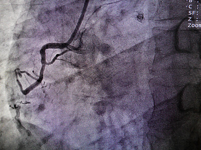 在右冠心动动脉处的STEMI高清图片