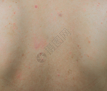 瘢痕疙瘩后背有红斑和黑棕色斑点 在妇女背部皮肤上背景