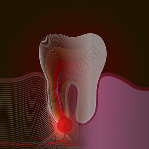 神经感染射线效应 从真牙到带有疼痛和炎症点的线性 X 射线效果的过渡 牙根炎症牙根囊性牙髓炎的医学插图插画