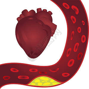 高血动脉和心脏(甲状腺硬质病)插图设计图片