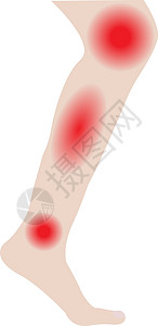 脚受伤的素材脚和脚踝与感染或受伤的间隔插图皮肤风险医学疾病短袜扭伤肿胀血管身体插画