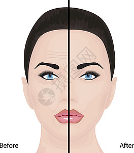 v脸提升老化面部提升皱纹治疗美容整容复兴设计图片