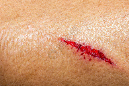 人体皮肤尖锐物体造成的深处伤口高清图片