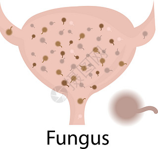 实用程序尿道感染 充满真菌感染的螺旋状菌插画