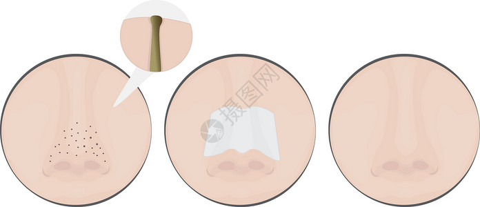 阻塞的鼻子上的黑头治疗前后化妆品美丽女孩疙瘩护理皮肤奶油皮肤科疾病卫生设计图片