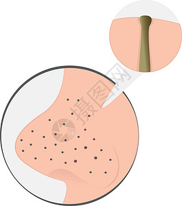 疙瘩鼻子上的黑头皮肤科青春期美丽疾病卫生护理缺陷治疗奶油女孩设计图片