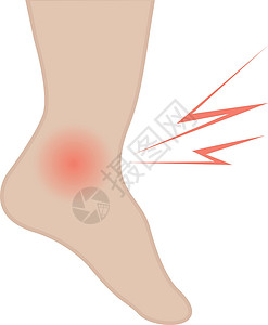 脚踝疼痛脚和脚踝与感染或受伤的间隔短袜治疗插图血管医学症状皮肤扭伤压缩重量插画