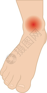 脚受伤的素材脚和脚踝与感染或受伤的间隔卡通片医学肿胀重量插图破产皮肤医师疾病水疱设计图片