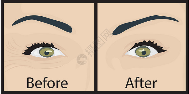 缓解眼部疲劳去除眼睛下方的皱纹和细纹 之前和之后 眼睛提升压力眼部圆圈虚胖美容护理症状女孩肤色女性插画