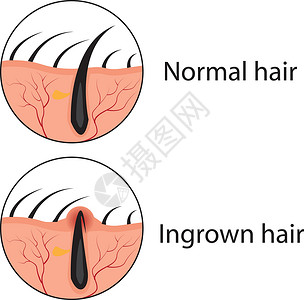 疙瘩普通和不生长的毛发矢量图设计图片