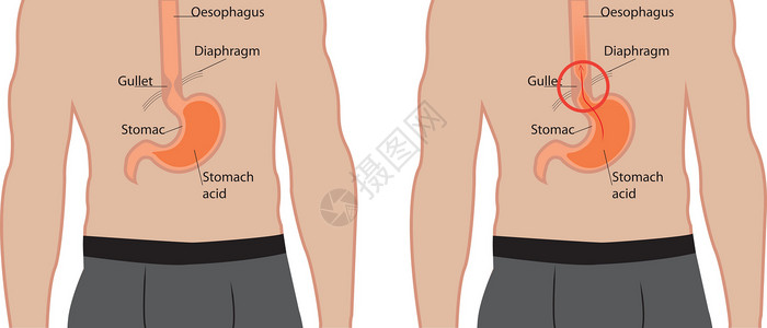 胃食管反流病 人体内的胃食管烧伤症状科学保健插图胃炎身体男人消化插画