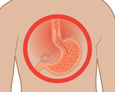 以病人为中心胃部在白色背景的人体病媒图解中心脏灼伤 腹部为白种背景下的人体矢量插画