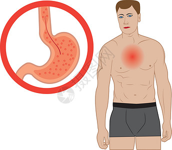 胃灼热胃食管反流病 人体内的胃疼痛器官食管疾病气体解剖学科学胃炎烧伤括约肌插画