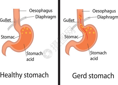 胃食管酸反流病  Gerd 和健康胃载体它制作图案高清图片