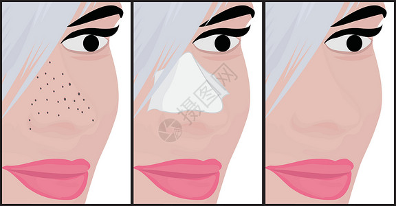 鼻子黑头鼻子上的黑头疾病皮肤科皮肤护理卫生奶油女士保健青春期缺陷设计图片