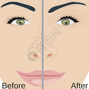 毛孔堵塞污垢鼻子治疗前后去除黑头 毛孔缩小皮肤问题设计图片