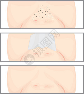 毛孔堵塞污垢鼻子上的黑头护理面具温泉治疗皮肤缺陷毛孔疾病奶油女士设计图片