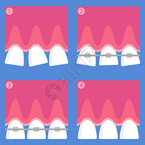 造口护理牙齿 牙科护理背景 矫形治疗 卡通开胃口金属医生卫生牙医工具矫正诊所医院微笑支撑插画