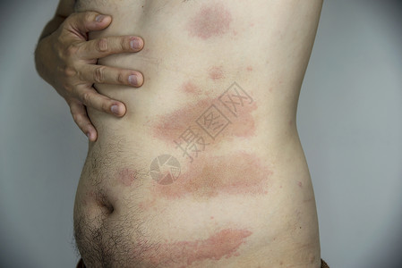 皮肤病学男人身体部位出现红色皮疹 — 有皮肤过敏问题概念的人背景