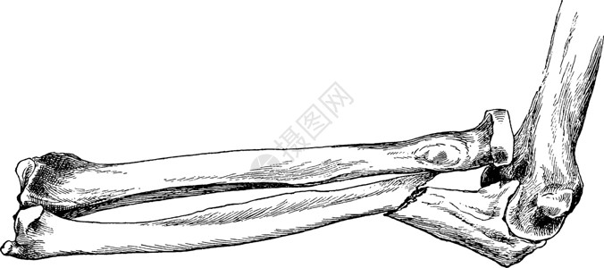 桡骨脱位的尺骨骨折复古插图背景图片