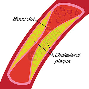 血栓弹力图血凝块和胆固醇斑块 血管阻塞插画