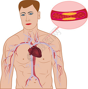 心脏冠状血管血管中胆固醇斑块的水平测试治疗疾病插图动脉粥样硬化心脏病攻击心脏牌匾诊断设计图片