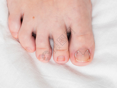 虎爪脚趾甲夹在土生的脚趾甲上治疗夹钳支撑护士化妆品药品指甲嵌甲指甲钳修脚背景