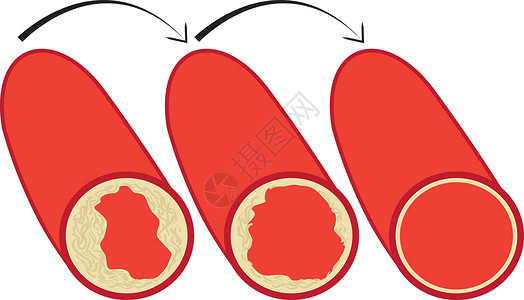 冠状动脉粥样硬化性心脏病降低血管中胆固醇斑块的水平设计图片
