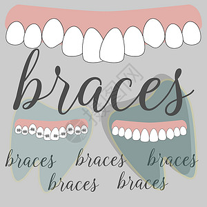 在美丽的风格大括号牙科 矢量平面设计插画成人保健微笑牙齿诊所支撑金属医生牙医插图插画