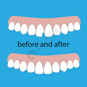 咬牙蓝色背景上的牙科修复插图矢量 牙科概念医生横幅微笑治疗卫生口服诊所药品减员保健插画