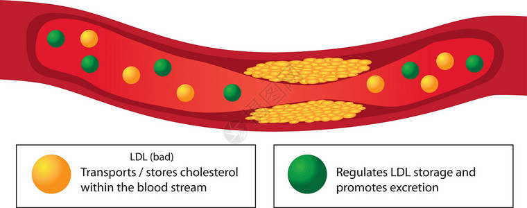 脂类血管中的动脉粥样硬化斑块和脂质的好坏插画