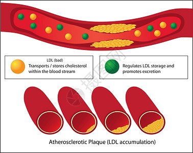 血管堵塞好血脂和坏血脂以及动脉粥样硬化斑块水平在血管医学中的作用插画