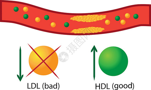 调节血脂血管中的动脉粥样硬化斑块 血液中好血脂和坏血脂的调节插画