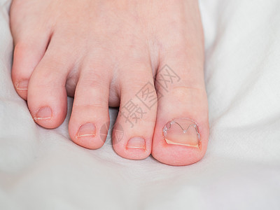 虎爪脚趾甲夹在土生的脚趾甲上疾病化妆品外科角膜嵌甲病人治疗夹钳药品支撑背景