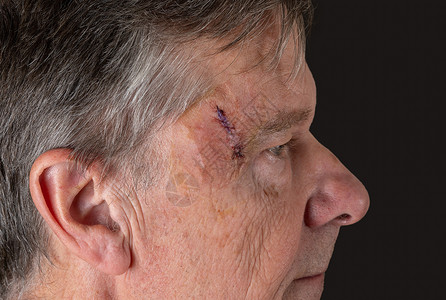 卫生部外科手术后老年人的侧视角 以去除伤口上的皮肤癌缝针晒黑皮肤医疗身体病人损害治疗老年癌症疾病背景