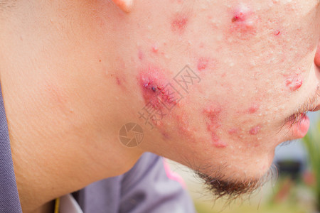 丘疹性荨麻疹男性脸颊与大小孔或的横向相片a背景