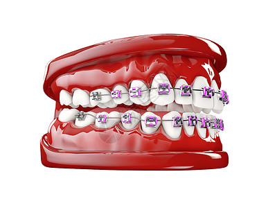 托槽矫正带托槽的牙齿牙齿护理概念 3d 它制作图案磨牙支撑牙科牙医药品凹痕金属矫正宏观插图背景