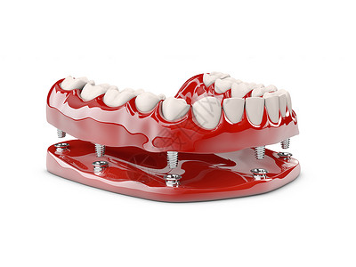 牙齿断裂人体牙齿和牙科植入3图例插图搪瓷医生本质脓肿凹痕诊所抗生素假肢空腔背景