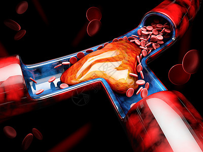 栓子3d 深肠血栓或血衣说明生物学动脉攻击静脉动脉硬化绘画疼痛中风图表插图背景