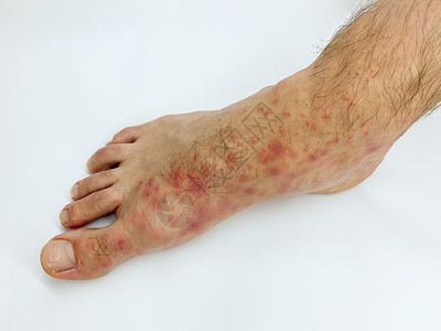雄性的脚跟和脚趾贴近了 发红疹发炎疾病侵蚀皮炎皮肤细菌治疗身体医生湿疹疼痛背景
