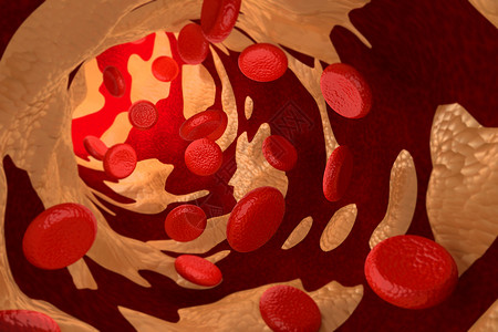 3D型三氯苯丙醇甲酸胆酯醇粉末导致的动脉硬化背景图片