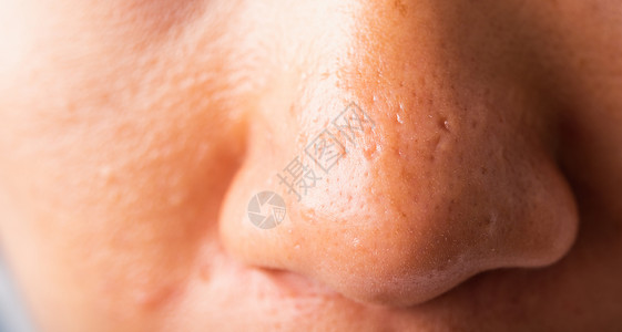 毛孔出大女人大的毛孔有雀斑脸颊油润滑 鼻子上刺鼻白头女孩瑕疵细菌皮肤科成人皮脂卫生女士女性背景