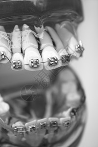 陶瓷托槽矫正带有彩色钩子的古老牙科金属整形牙眼牙齿治疗工具制品医疗学生陶瓷微笑矫正色结背景